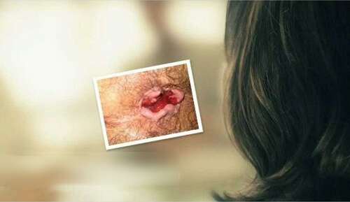 Bệnh trĩ có trị hết không?